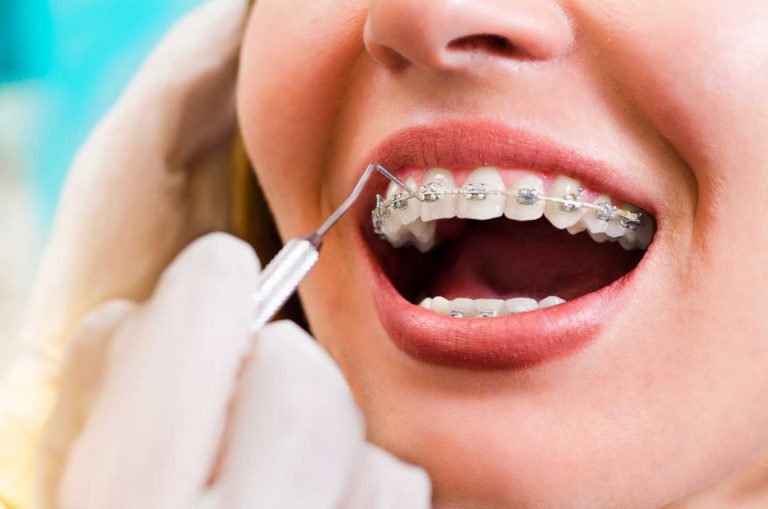 Braces in Calgary AB Beacon Smiles