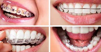 Braces in Calgary AB - Beacon Smiles