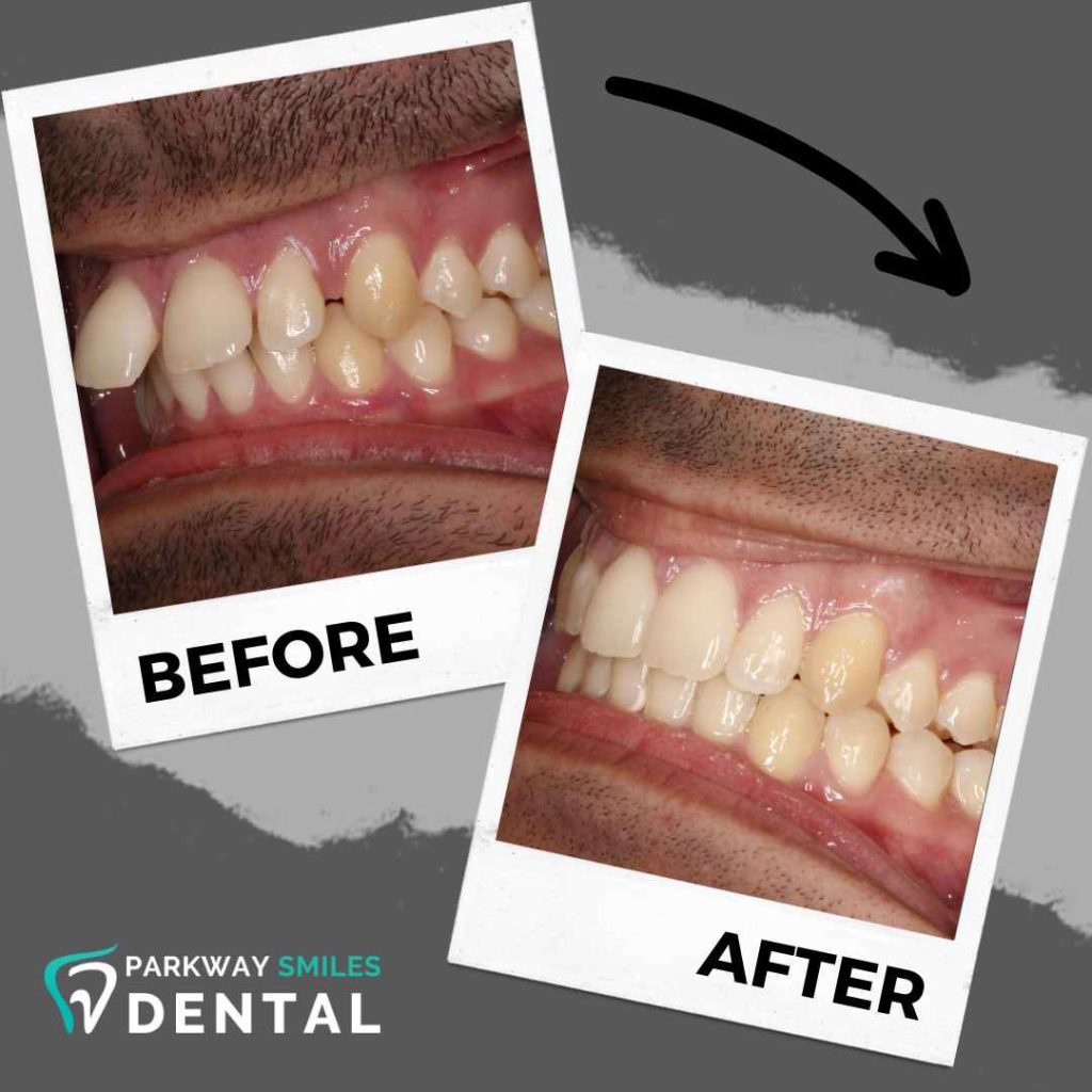Before-and-After-Parkway-Smiles-Orthodontics-in-Calgary-10.jpg