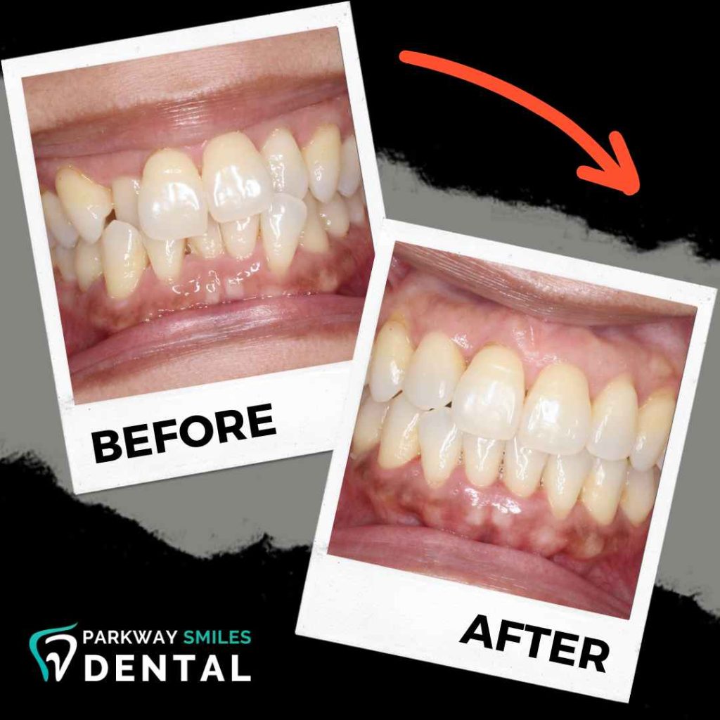 Before-and-After-Parkway-Smiles-Orthodontics-in-Calgary-11.jpg