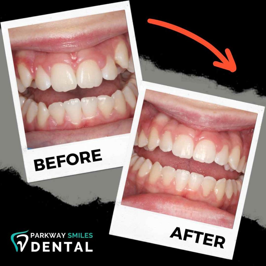 Before-and-After-Parkway-Smiles-Orthodontics-in-Calgary-12.jpg