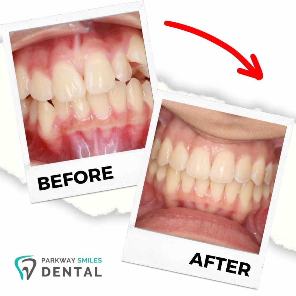 Before-and-After-Parkway-Smiles-Orthodontics-in-Calgary-13.jpg