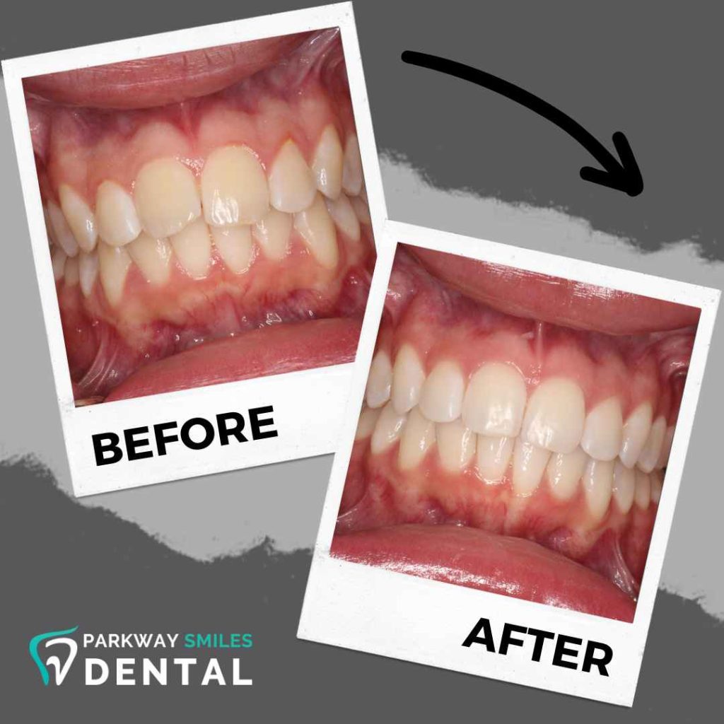 Before-and-After-Parkway-Smiles-Orthodontics-in-Calgary-14.jpg