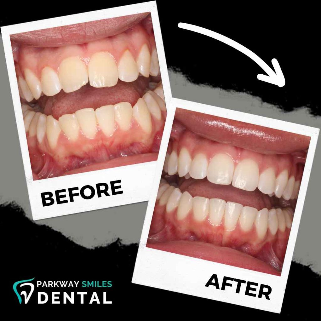 Before-and-After-Parkway-Smiles-Orthodontics-in-Calgary-15.jpg