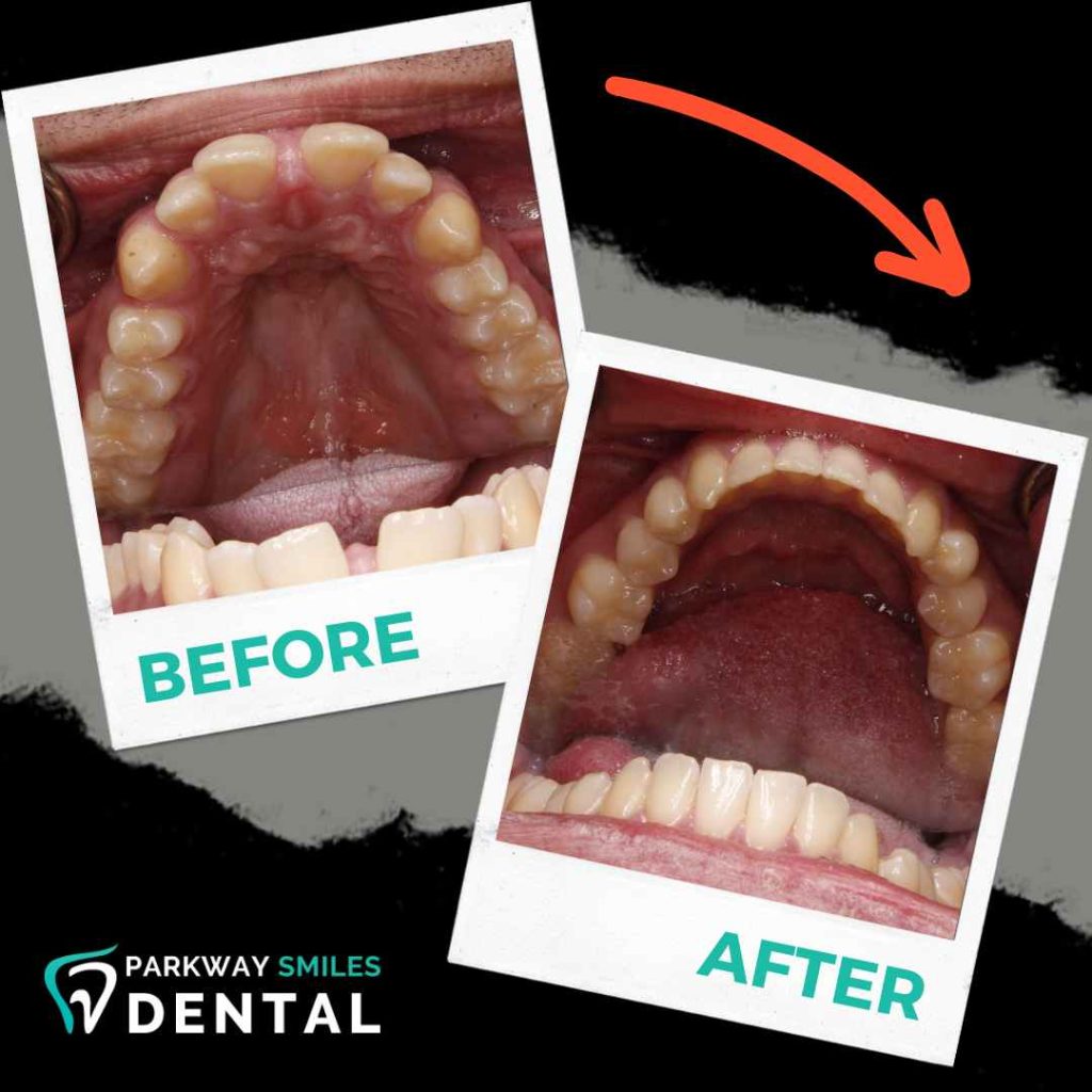Before-and-After-Parkway-Smiles-Orthodontics-in-Calgary-2.jpg