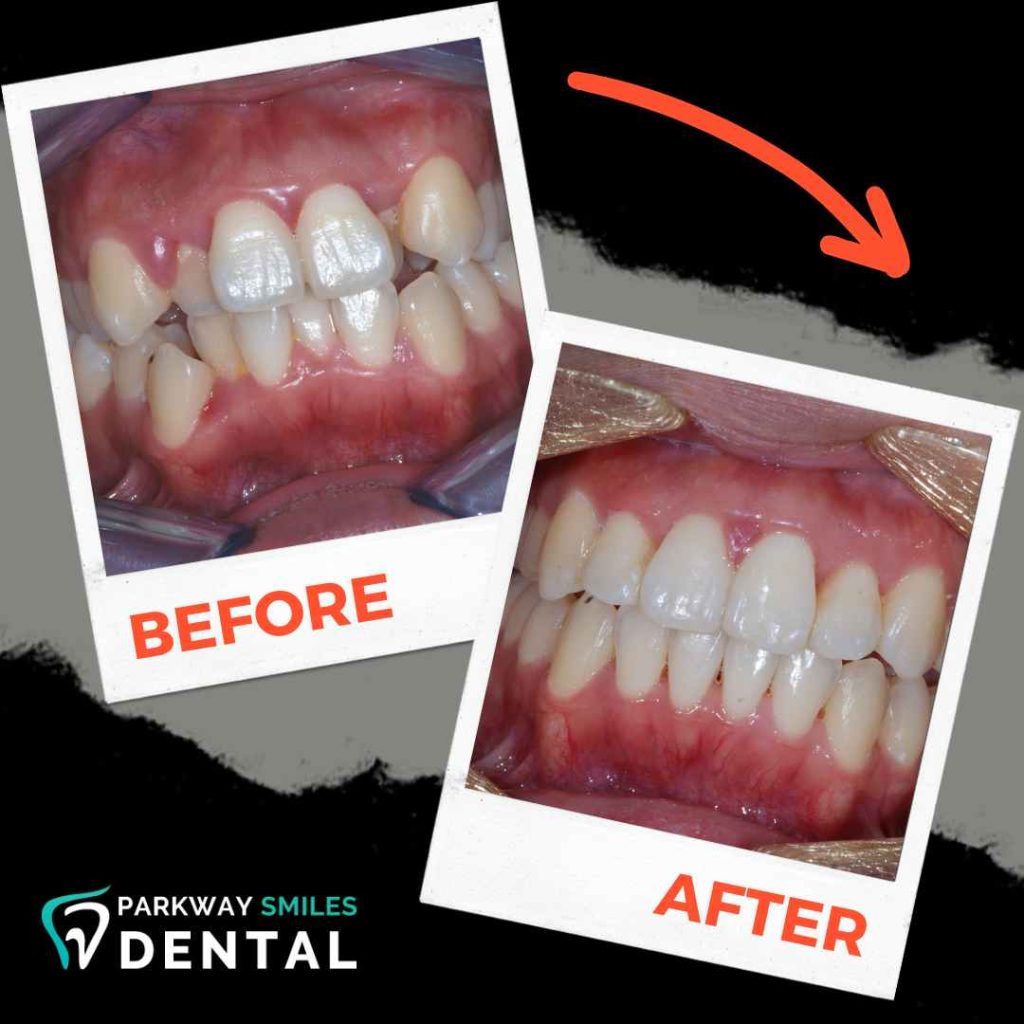 Before-and-After-Parkway-Smiles-Orthodontics-in-Calgary-3.jpg