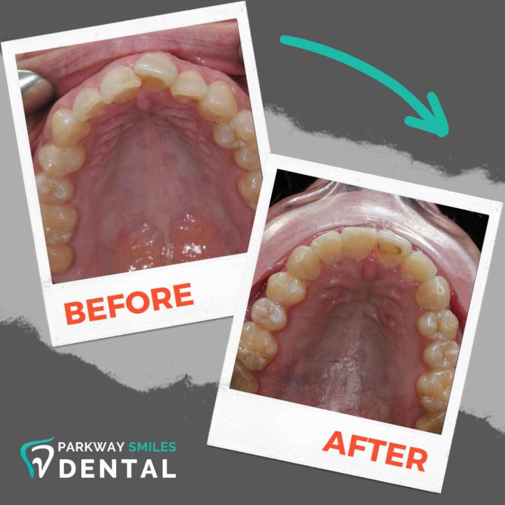 Before-and-After-Parkway-Smiles-Orthodontics-in-Calgary-5.jpg