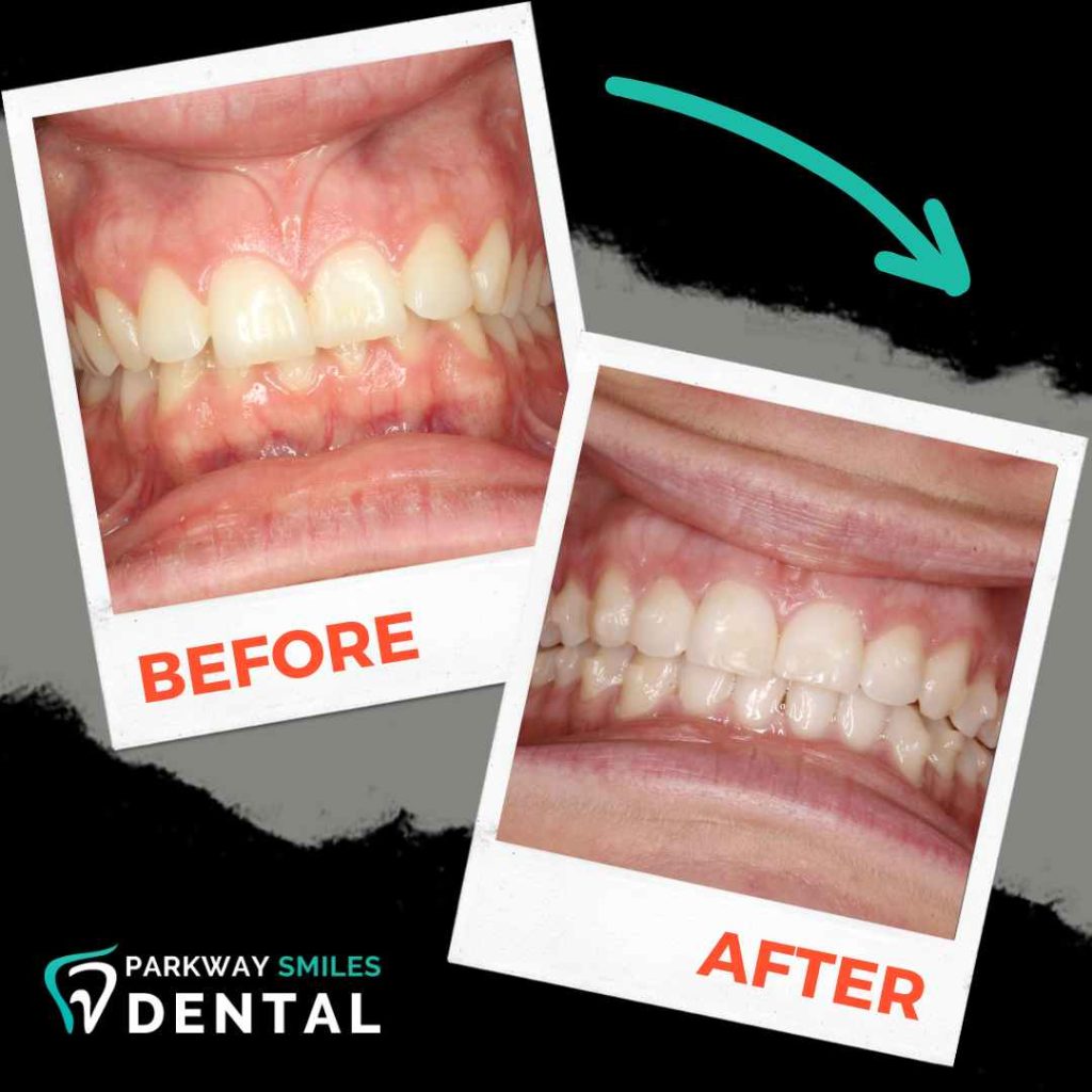 Before-and-After-Parkway-Smiles-Orthodontics-in-Calgary-6.jpg