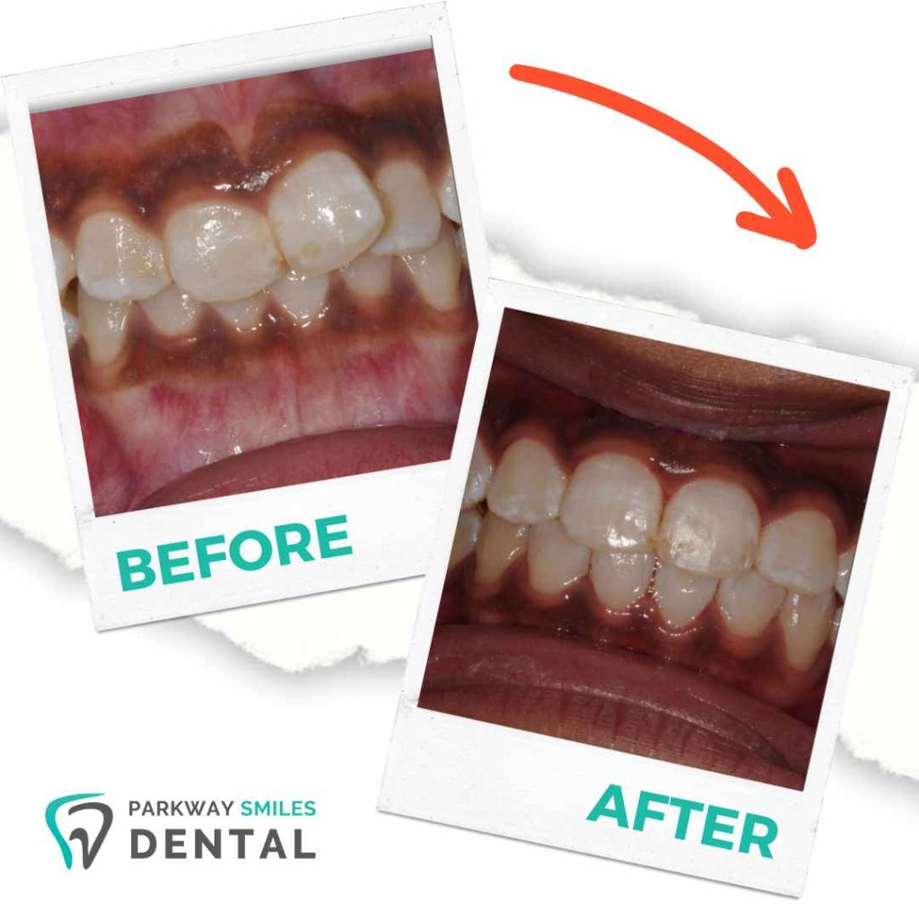 Before-and-After-Parkway-Smiles-Orthodontics-in-Calgary-7.jpg