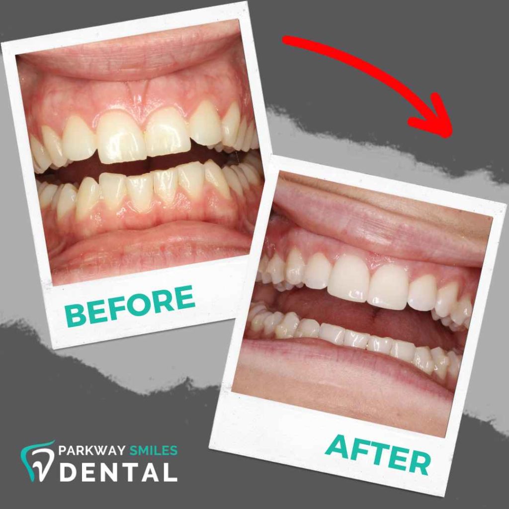 Before-and-After-Parkway-Smiles-Orthodontics-in-Calgary-8.jpg