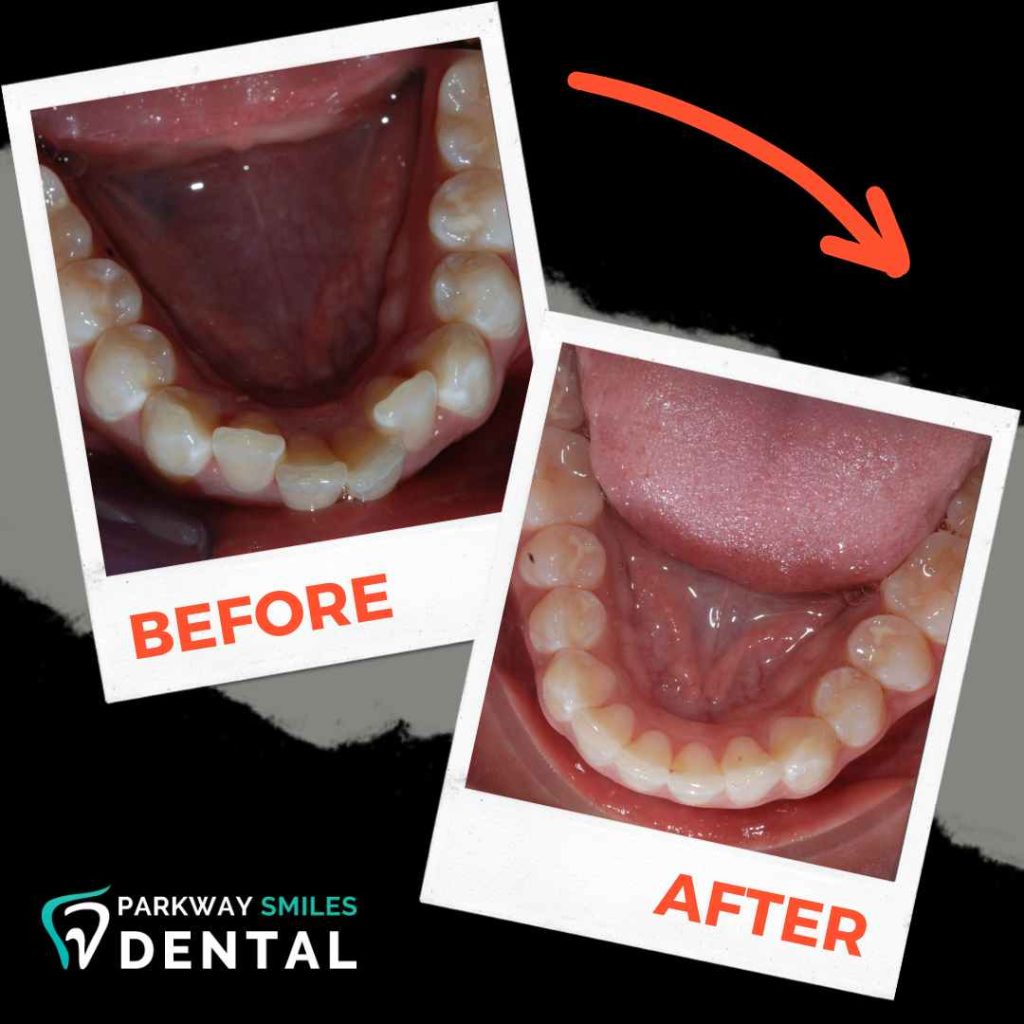Before-and-After-Parkway-Smiles-Orthodontics-in-Calgary-9.jpg